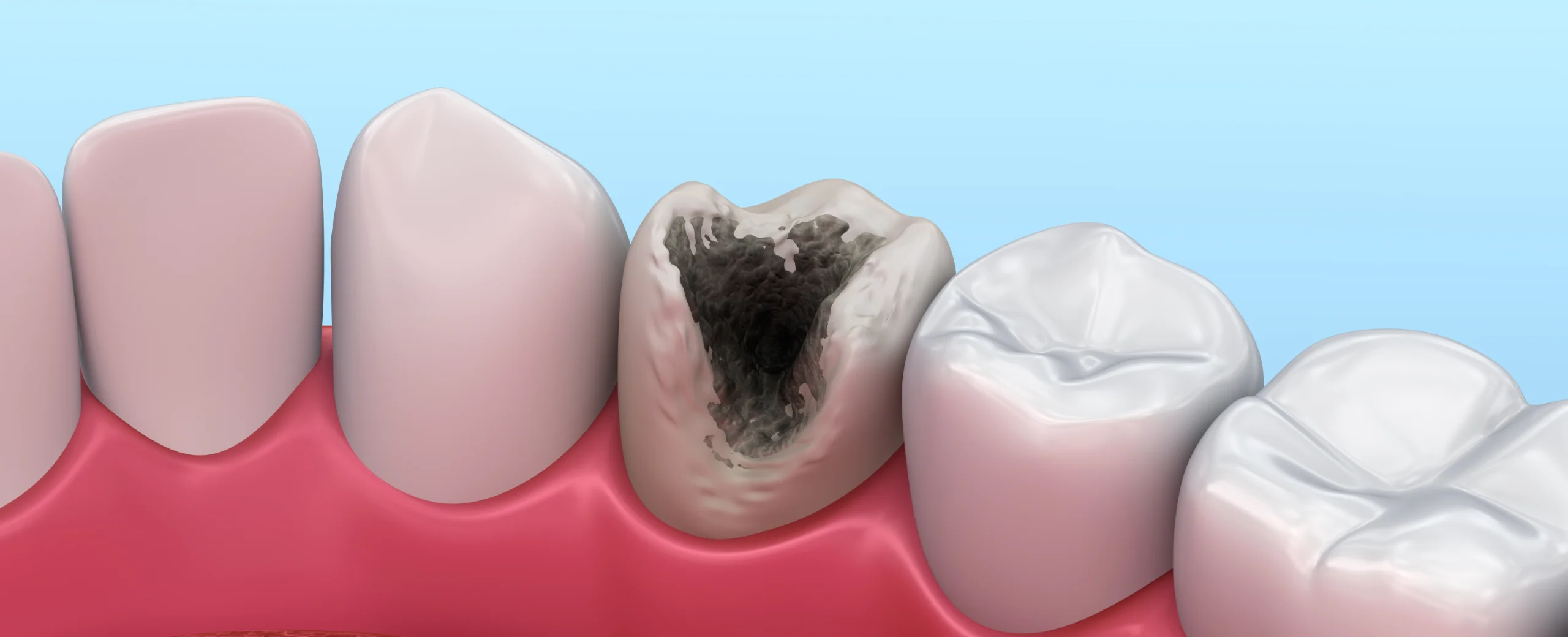 Pulpitis – Wenn der Zahnschmerz zur Qual wird